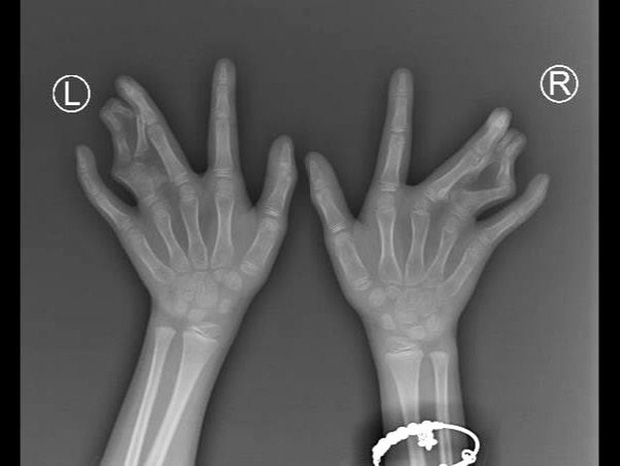 Một dòng họ ở Tiền Giang bị dị tật càng cua hiếm gặp-3