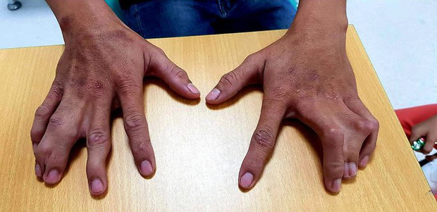 Một dòng họ ở Tiền Giang bị dị tật càng cua hiếm gặp-4