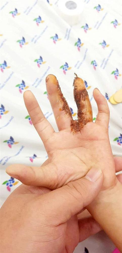 Một dòng họ ở Tiền Giang bị dị tật càng cua hiếm gặp-5