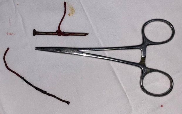 Tai nạn kinh hoàng lúc làm việc: Người đàn ông bị cây đinh cắm thẳng vào mắt trái, phải múc bỏ nhãn cầu-1