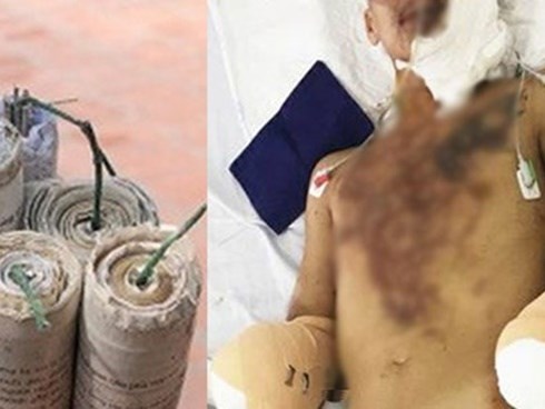 Hiểm họa kinh hoàng của pháo tự chế, chuyên gia cảnh cáo: Đừng có dại mà đùa với lửa!