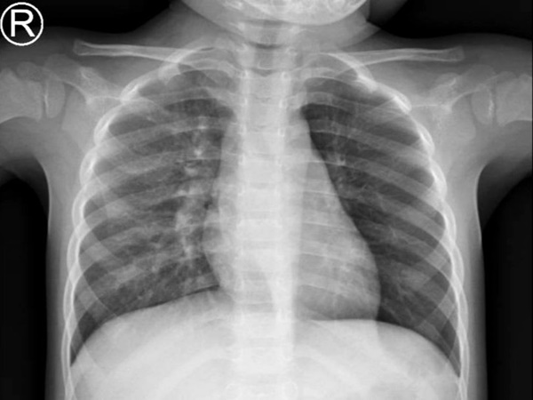 Bé gái 3 tuổi được chẩn đoán viêm phổi nhưng 2 tháng sau, gia đình mới phát hiện sự thật-1