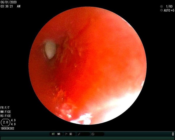 Bé gái 3 tuổi được chẩn đoán viêm phổi nhưng 2 tháng sau, gia đình mới phát hiện sự thật-2