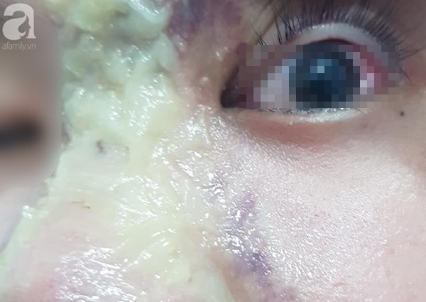 Nhẹ dạ đi tiêm filler nâng mũi tại spa trôi nổi, thiếu nữ 15 tuổi bị mù vĩnh viễn mắt trái ngày cận Tết-2