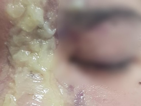 Cận cảnh hình ảnh nâng mũi hỏng của cô gái trẻ khiến nhiều người sợ co rúm!-7