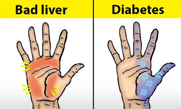 Người có chức năng gan ổn định sẽ không có 4 điểm sau trên đôi tay, cùng xem bạn có điểm nào hay không-1