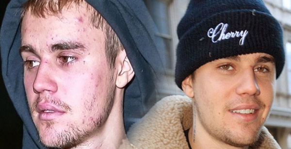Justin Bieber thực ra đang mắc cùng lúc 2 căn bệnh đáng sợ khiến cho thân hình trở nên tàn tạ, mặt nổi đầy mụn-2