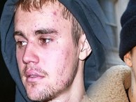 Justin Bieber thực ra đang mắc cùng lúc 2 căn bệnh đáng sợ khiến cho thân hình trở nên tàn tạ, mặt nổi đầy mụn