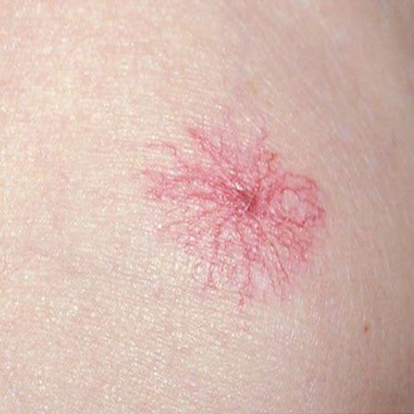 6 dấu hiệu tiền ung thư gan bạn nên để ý, đừng để cái chết đến gần-4