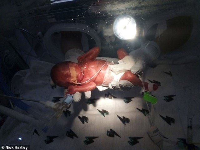 23 tuần đã bị đẻ, bé trai chỉ nặng 0,6kg, dài đúng bằng gang tay mẹ sống sót kỳ diệu-1