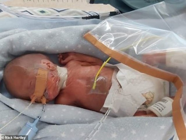 23 tuần đã bị đẻ, bé trai chỉ nặng 0,6kg, dài đúng bằng gang tay mẹ sống sót kỳ diệu-5