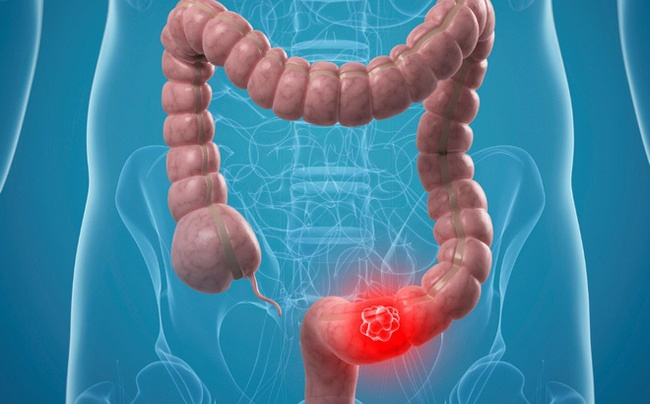 Tâm thư của người phụ nữ 26 tuổi từ chối kiểm tra nội soi vì quá đắt, kết quả bị ung thư giai đoạn cuối-2