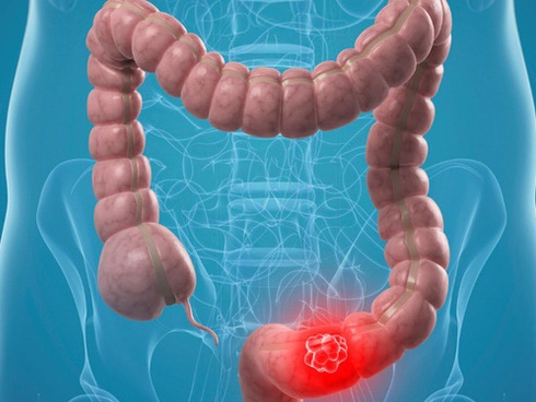 Ung thư lưỡi ngày càng phổ biến, bác sĩ cảnh báo 4 nguyên nhân gây bệnh-4