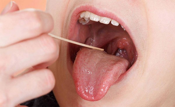 Ung thư lưỡi ngày càng phổ biến, bác sĩ cảnh báo 4 nguyên nhân gây bệnh-1