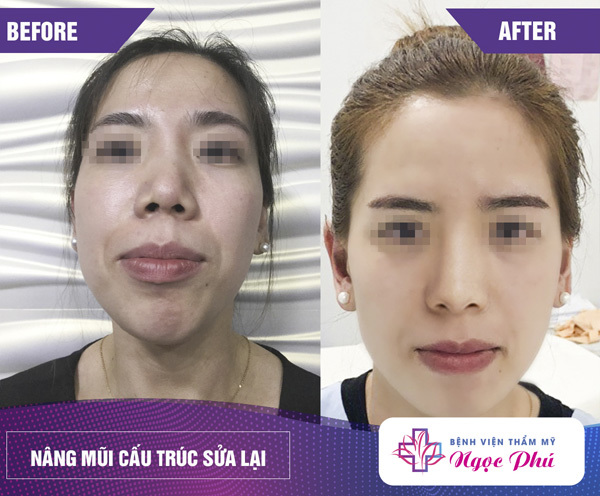 Nâng mũi cấu trúc Rebuild - giải pháp cho mũi hỏng-5