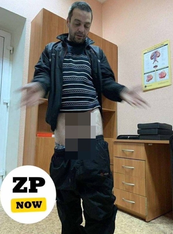 Bị vợ đeo khóa chống hư vào của quý, chồng phải nhờ bác sĩ cưa nó ra không là mất khả năng sinh đẻ-1