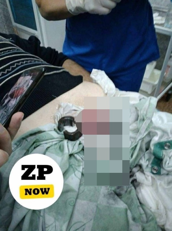 Bị vợ đeo khóa chống hư vào của quý, chồng phải nhờ bác sĩ cưa nó ra không là mất khả năng sinh đẻ-2