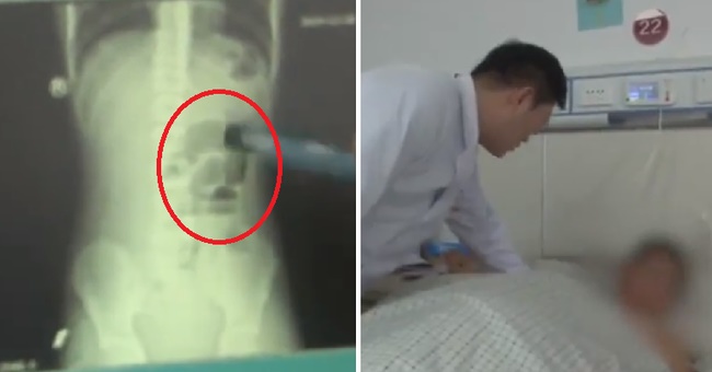 Đau bụng không chịu nổi, đi khám bác sĩ nói tắc ruột, hóa ra nguyên nhân là do nhai viên trân châu trong trà sữa trân châu không đúng cách-1