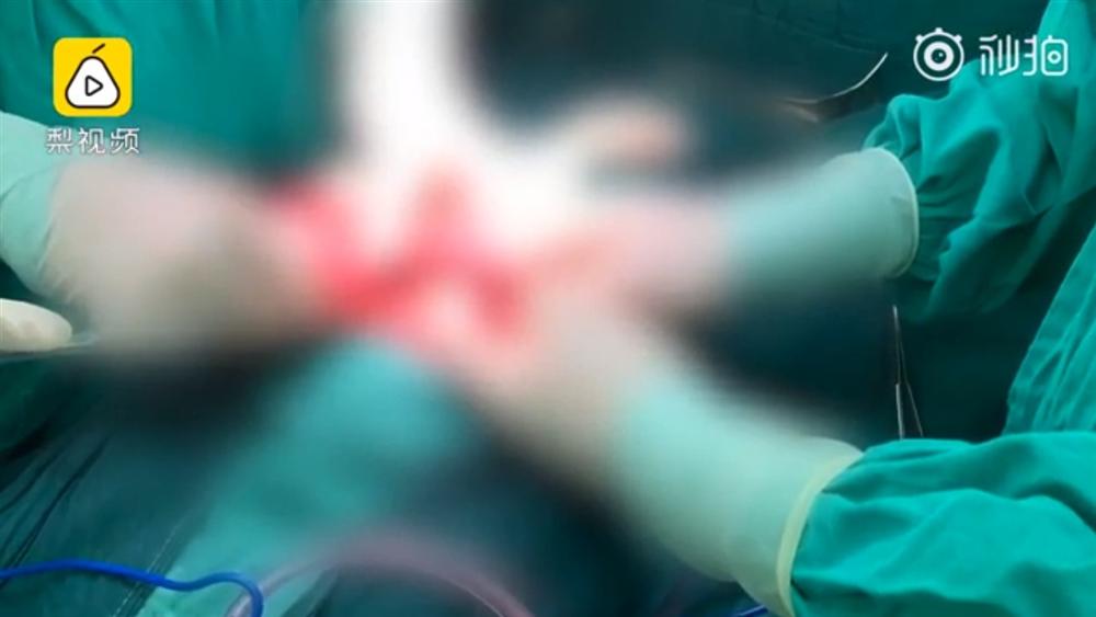 Đau bụng không chịu nổi, đi khám bác sĩ nói tắc ruột, hóa ra nguyên nhân là do nhai viên trân châu trong trà sữa trân châu không đúng cách-2