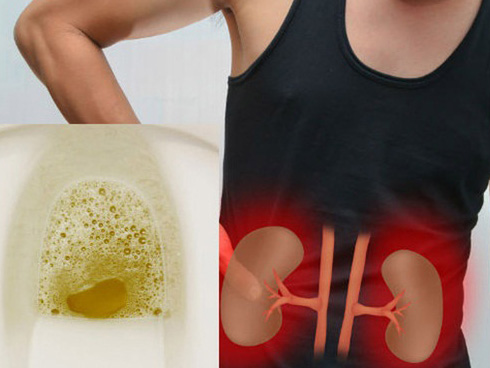 Bác sĩ cảnh báo 5 hành vi thường thấy là nguyên nhân gây phá hủy” thận-5