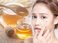 Ngày Tết bị nổi mụn, hãy 'cấp cứu' làn da bằng những mẹo đơn giản mà hiệu quả bất ngờ
