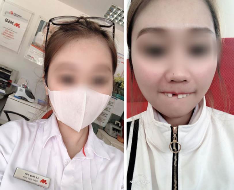 Cắn hướng dương ngày Tết, cô gái trẻ bị... rụng cả răng cửa tốn thêm bạc triệu để làm mới-2