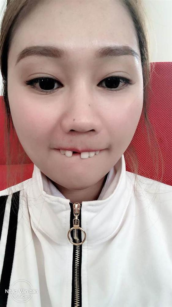 Cắn hướng dương ngày Tết, cô gái trẻ bị... rụng cả răng cửa tốn thêm bạc triệu để làm mới-4