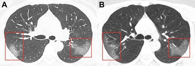 Chụp X-quang phổi cho bệnh nhân 33 tuổi nhiễm virus corona, bác sĩ rùng mình phát hiện hình ảnh tương đồng dịch bệnh trong quá khứ-1