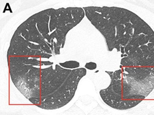 Chụp X-quang phổi cho bệnh nhân 33 tuổi nhiễm virus corona, bác sĩ rùng mình phát hiện hình ảnh tương đồng dịch bệnh trong quá khứ