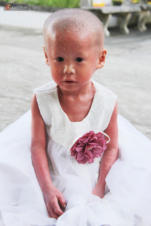 Cuộc sống hiện tại của em bé người đầy vẩy ngứa như da trăn, bị bố mẹ bỏ rơi trong bệnh viện-1