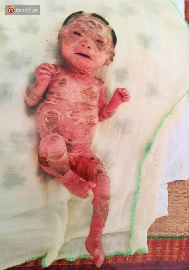 Cuộc sống hiện tại của em bé người đầy vẩy ngứa như da trăn, bị bố mẹ bỏ rơi trong bệnh viện-2