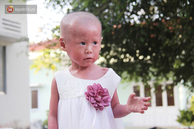 Cuộc sống hiện tại của em bé người đầy vẩy ngứa như da trăn, bị bố mẹ bỏ rơi trong bệnh viện-3