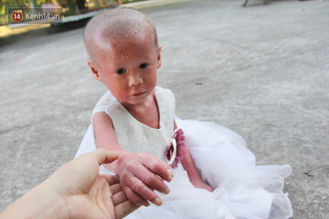 Cuộc sống hiện tại của em bé người đầy vẩy ngứa như da trăn, bị bố mẹ bỏ rơi trong bệnh viện-10