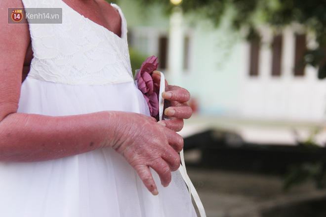 Cuộc sống hiện tại của em bé người đầy vẩy ngứa như da trăn, bị bố mẹ bỏ rơi trong bệnh viện-5