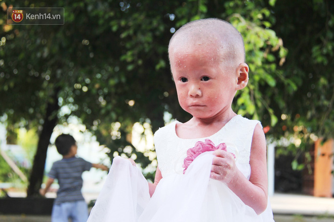 Cuộc sống hiện tại của em bé người đầy vẩy ngứa như da trăn, bị bố mẹ bỏ rơi trong bệnh viện-6