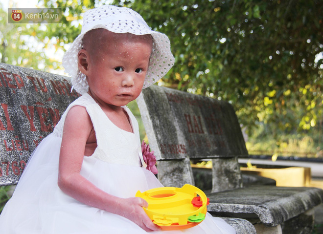 Cuộc sống hiện tại của em bé người đầy vẩy ngứa như da trăn, bị bố mẹ bỏ rơi trong bệnh viện-9