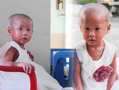 Cuộc sống hiện tại của em bé người đầy vẩy ngứa như da trăn, bị bố mẹ bỏ rơi trong bệnh viện