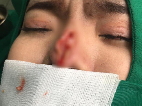 Đi nâng mũi cho thon gọn, nữ sinh viên bỗng nôn ra máu và đau bụng dữ dội đến chết, bác sĩ phẫu thuật đưa ra lý do gây choáng-2