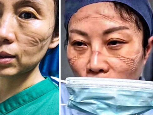Gương mặt biến dạng in hằn khẩu trang của y, bác sĩ Vũ Hán và đằng sau đó là chuỗi ngày ám ảnh chiến đấu chống virus corona