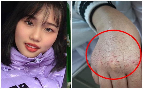 Gương mặt biến dạng in hằn khẩu trang của y, bác sĩ Vũ Hán và đằng sau đó là chuỗi ngày ám ảnh chiến đấu chống virus corona-1