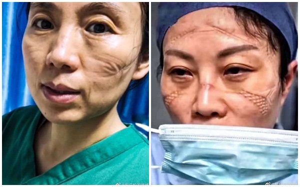 Gương mặt biến dạng in hằn khẩu trang của y, bác sĩ Vũ Hán và đằng sau đó là chuỗi ngày ám ảnh chiến đấu chống virus corona-3