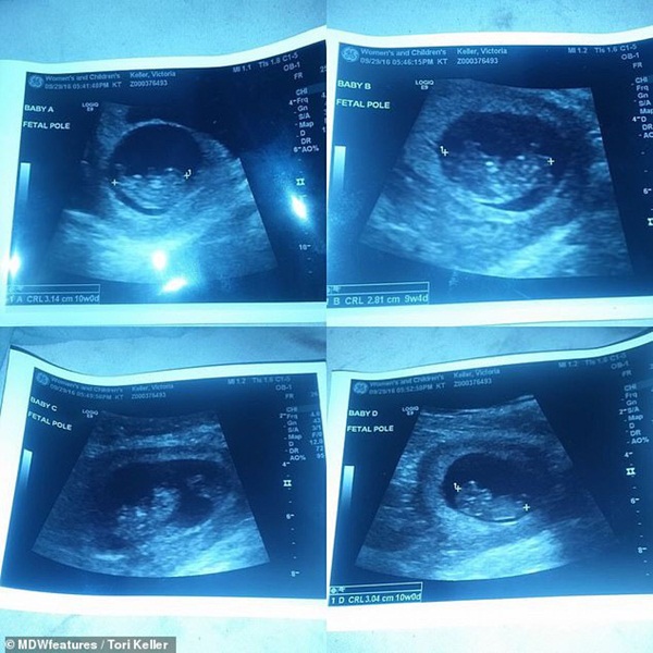 Mang thai 4, bà mẹ phải giữ 3 em bé đã mất trong bụng để đổi lấy sự an toàn cho thai nhi còn lại-2