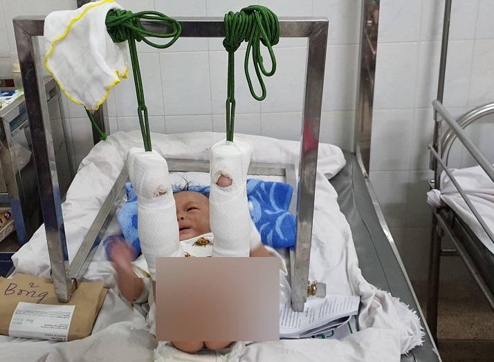 Bé trai 4 tháng tuổi nghi bị bố đánh đến xuất huyết não, gãy chân-1