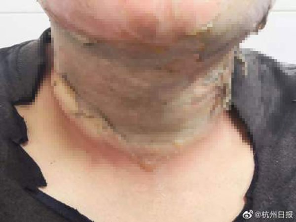 Cảnh báo từ trường hợp dùng cồn sát trùng tiêu diệt virus corona, người đàn ông bất ngờ bị lửa bén, nhập viện trong tình trạng bỏng nặng-1