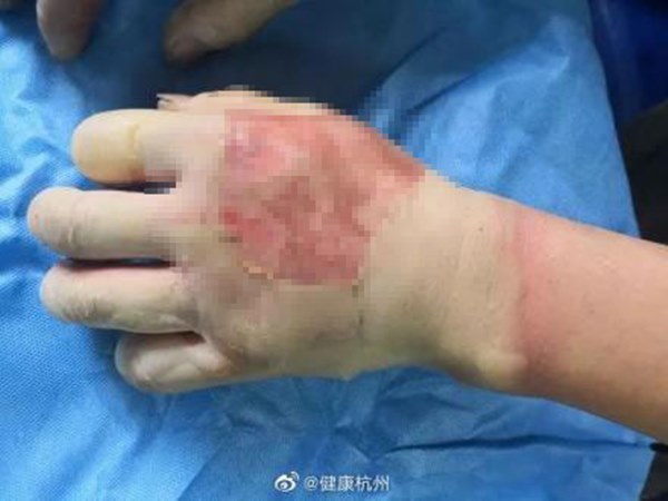 Cảnh báo từ trường hợp dùng cồn sát trùng tiêu diệt virus corona, người đàn ông bất ngờ bị lửa bén, nhập viện trong tình trạng bỏng nặng-2