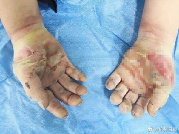 Cảnh báo từ trường hợp dùng cồn sát trùng tiêu diệt virus corona, người đàn ông bất ngờ bị lửa bén, nhập viện trong tình trạng bỏng nặng-3