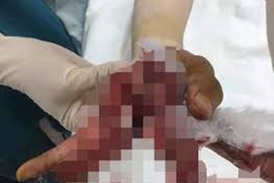 Thanh niên 19 tuổi phải cắt bỏ 3 ngón tay vì vừa sạc điện thoại vừa… chat