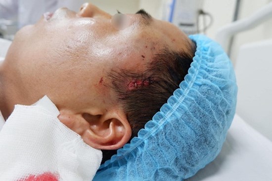 Nam thanh niên bị chảy máu ồ ạt do độn thái dương tại một cơ sở thẩm mỹ viện không phép