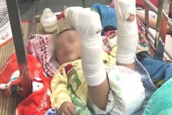 Làm giấy khai sinh cho bé 4 tháng bị bố đánh gãy chân: Mang họ mẹ, tên cha để trống