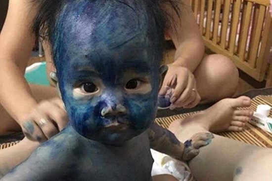 Sự thật về hai loại thuốc xanh, đỏ người mắc thủy đậu hay dùng